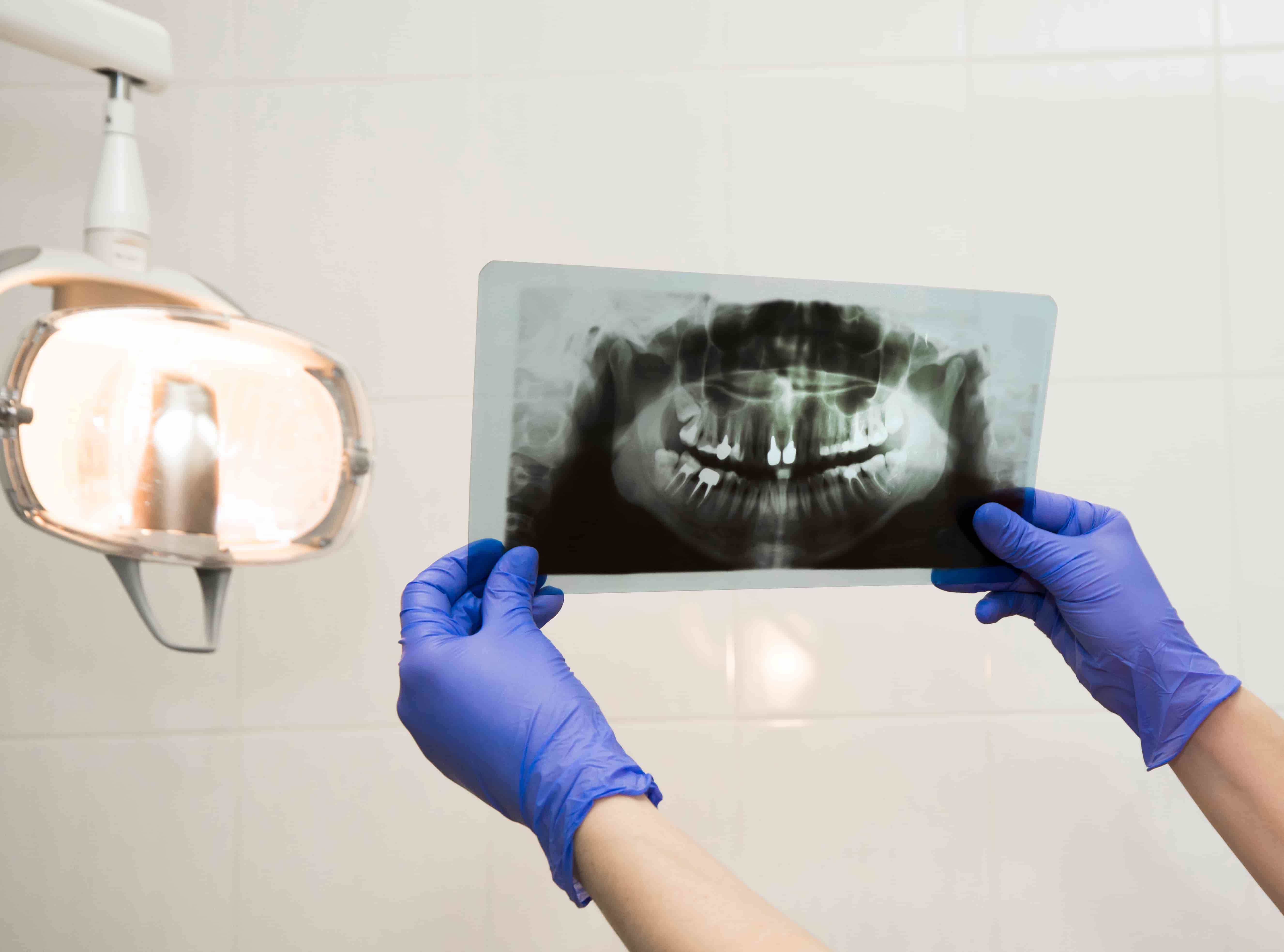 Digital Dental X-Rays